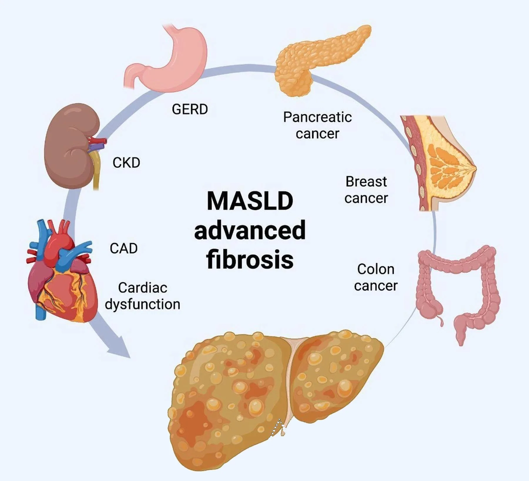 Illustration of the liver at the center of a ring of organs affected by MASLD: heart, kidneys, pancreas, blood vessels and other organs